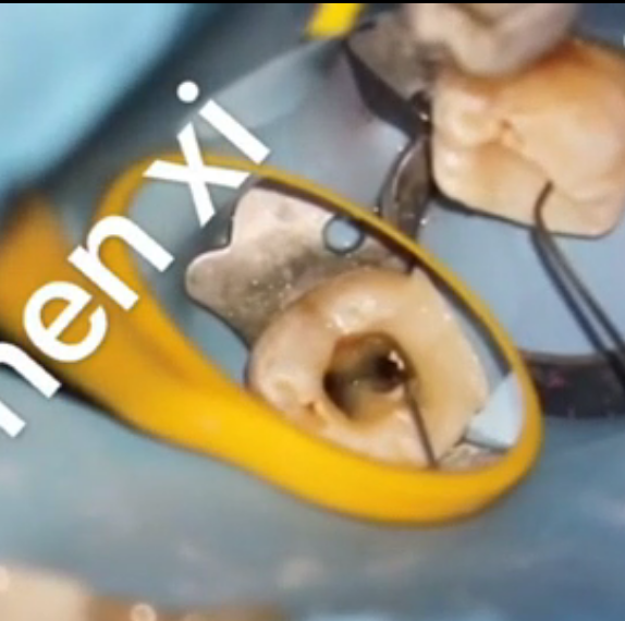 C-type root canal filling